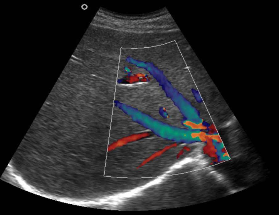 Узи допплер сосудов шеи. Доплер сканирование. Узи транскраниальная допплерография. Импульсно-волновой допплер в узи. Доплер сканирование.