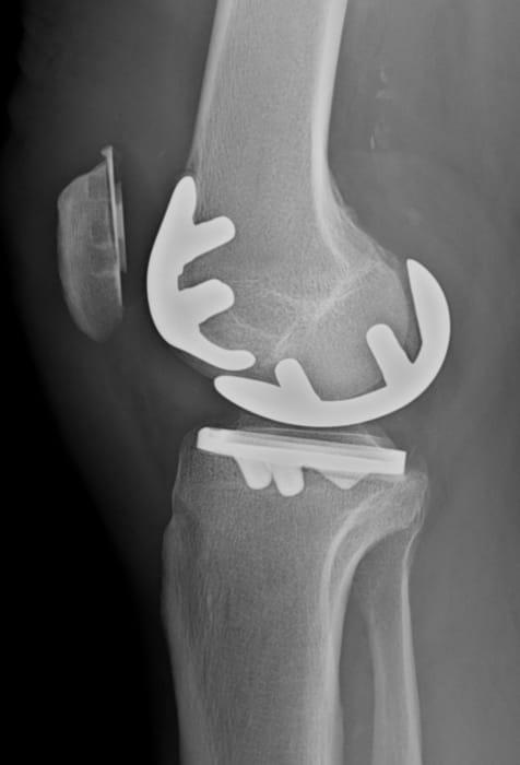 Traitement des fractures - Orthosud Montpellier